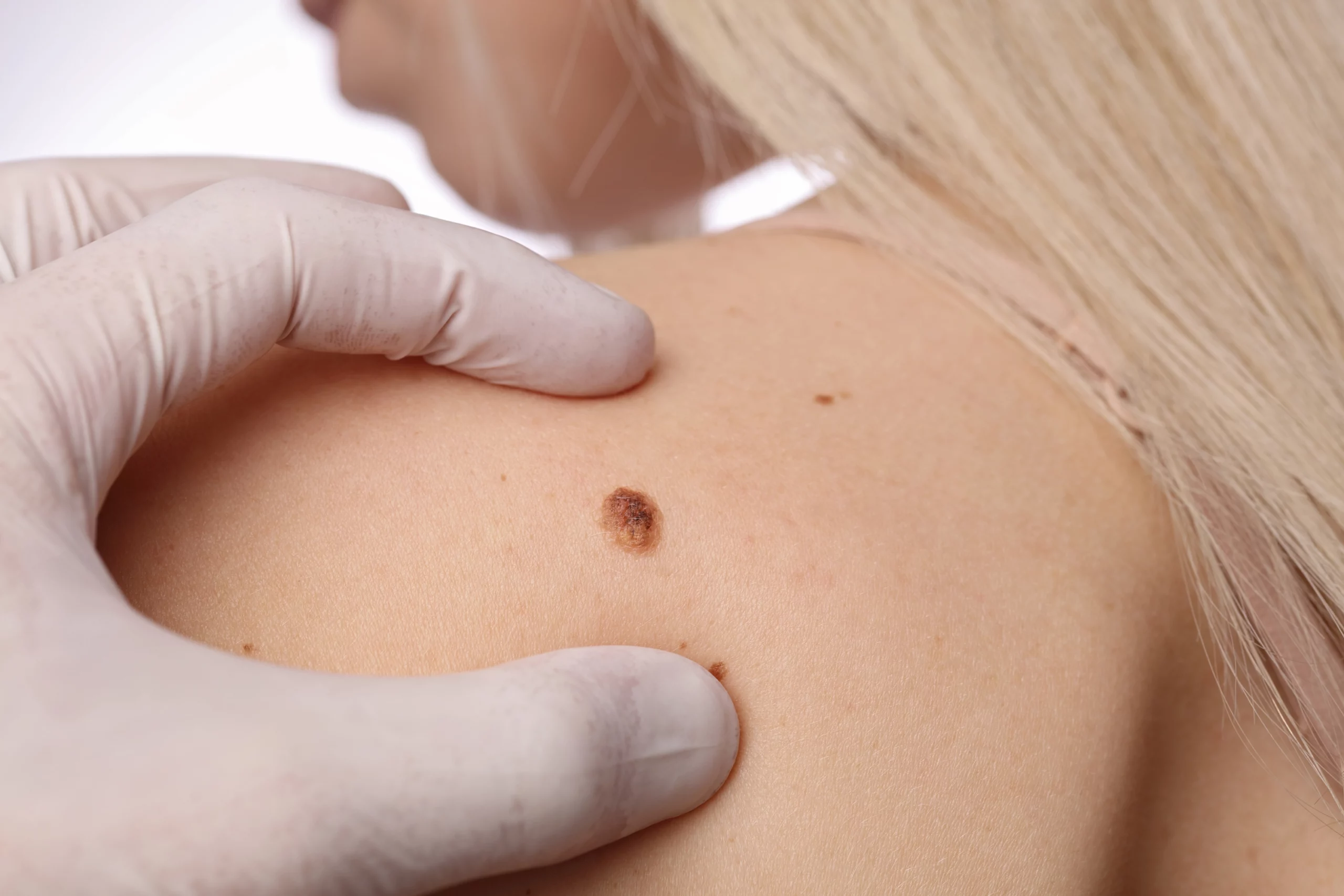 Dermatologist examines birthmark of patient close up