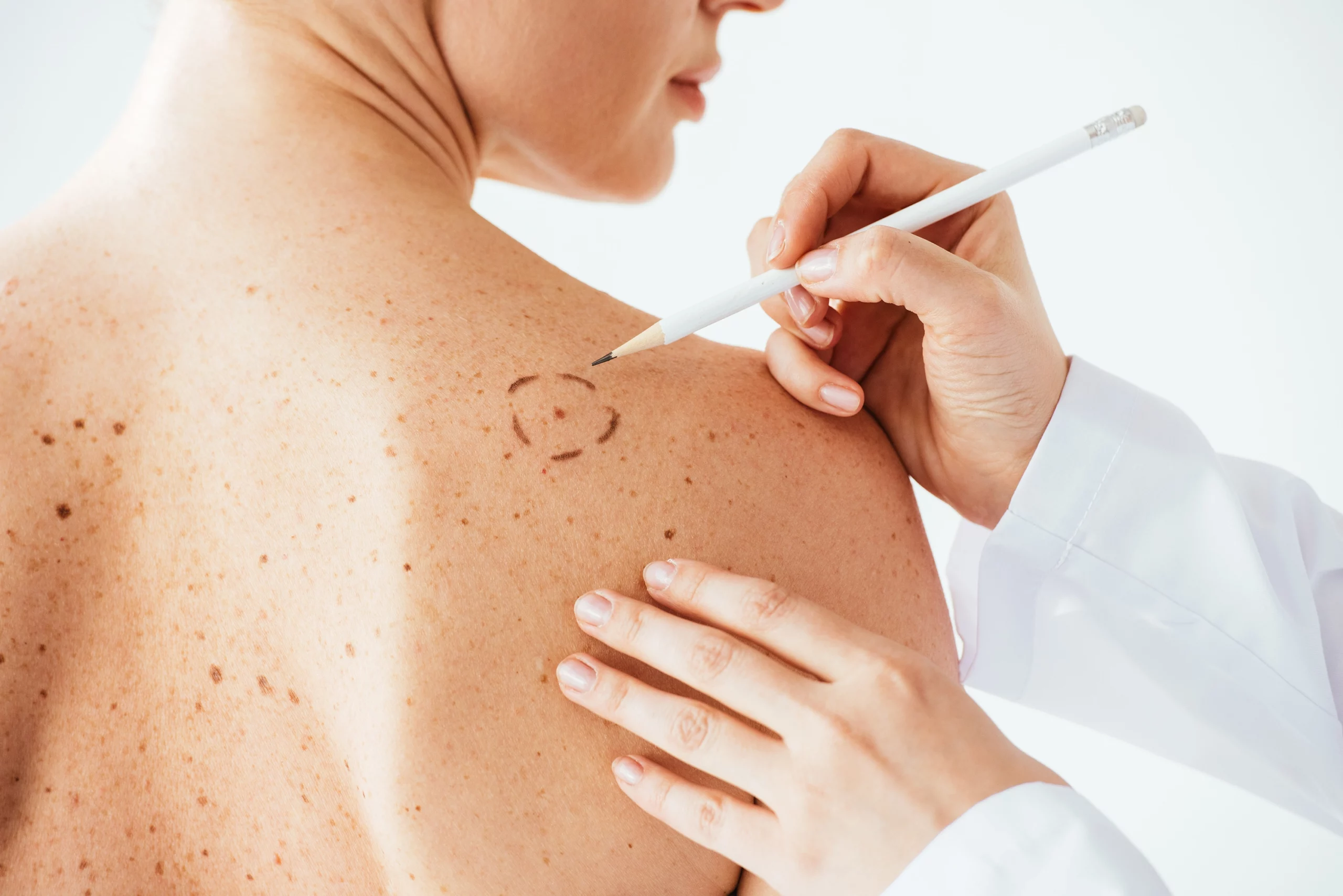 Dermatologist applying marks on skin of woman with melanoma